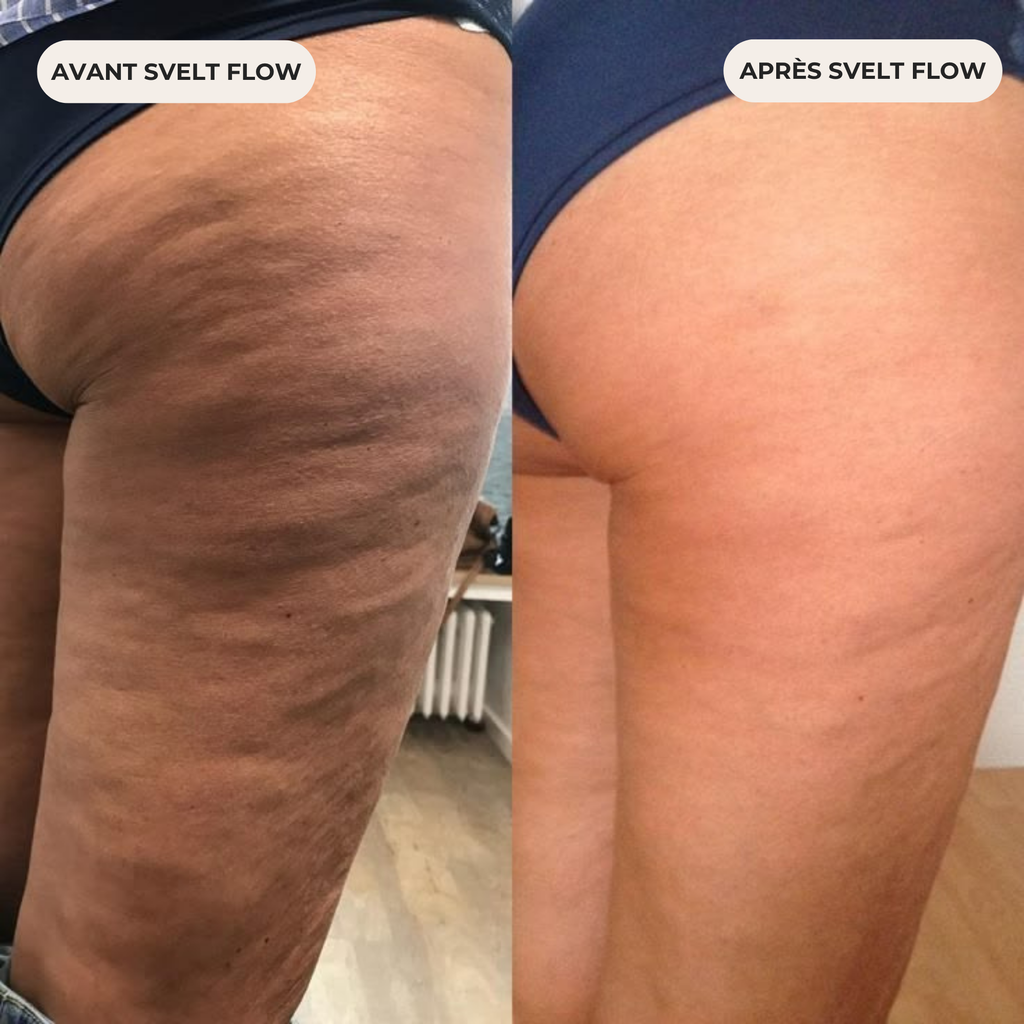 Révélez une peau visiblement plus lisse grâce à notre masseur corporel anti-cellulite SVELT Flow.